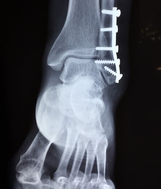 ankle-injury-cropped.jpg